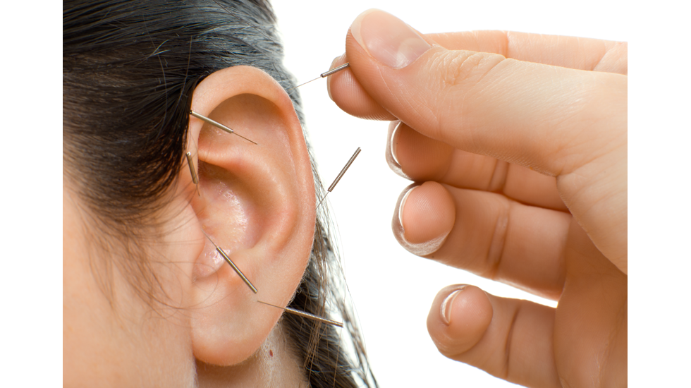 Ear Acupuncture
